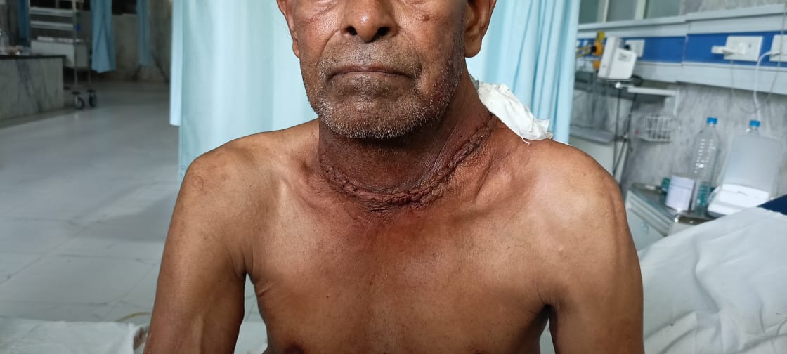 Ujjain News: आर. डी. गार्डी मेडिकल कॉलेज में डॉक्टरों द्वारा की गई अभूतपूर्व सर्जरी, मरीज की हालत में काफी सुधार