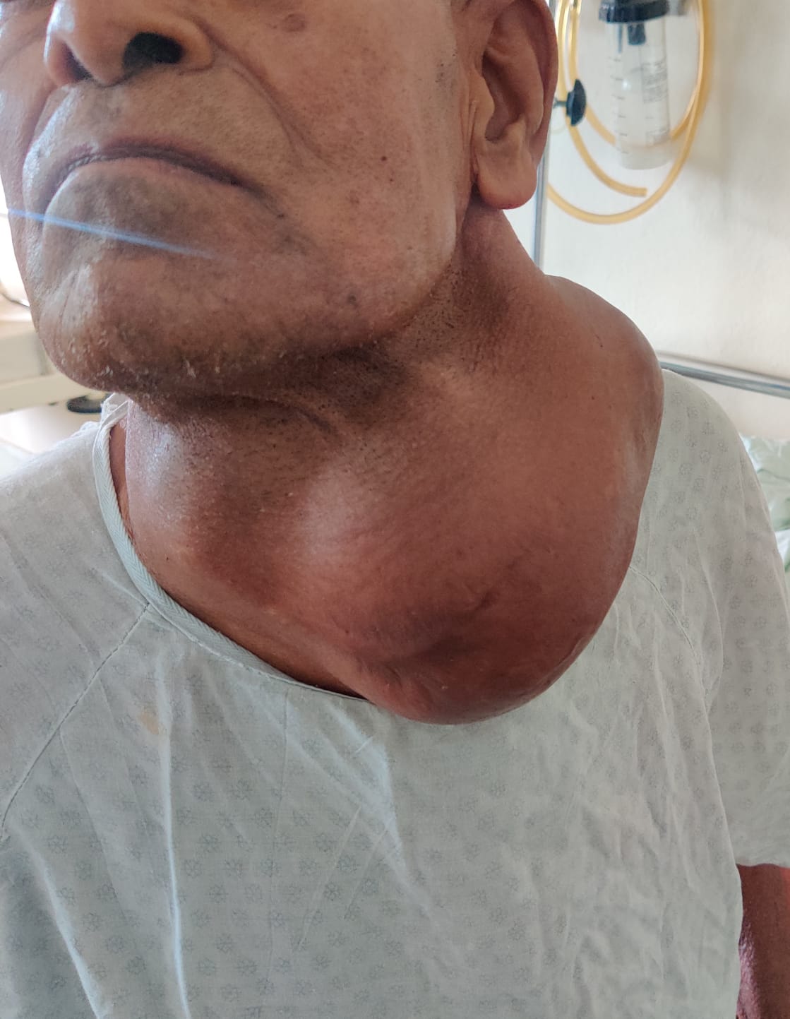 Ujjain News: आर. डी. गार्डी मेडिकल कॉलेज में डॉक्टरों द्वारा की गई अभूतपूर्व सर्जरी, मरीज की हालत में काफी सुधार