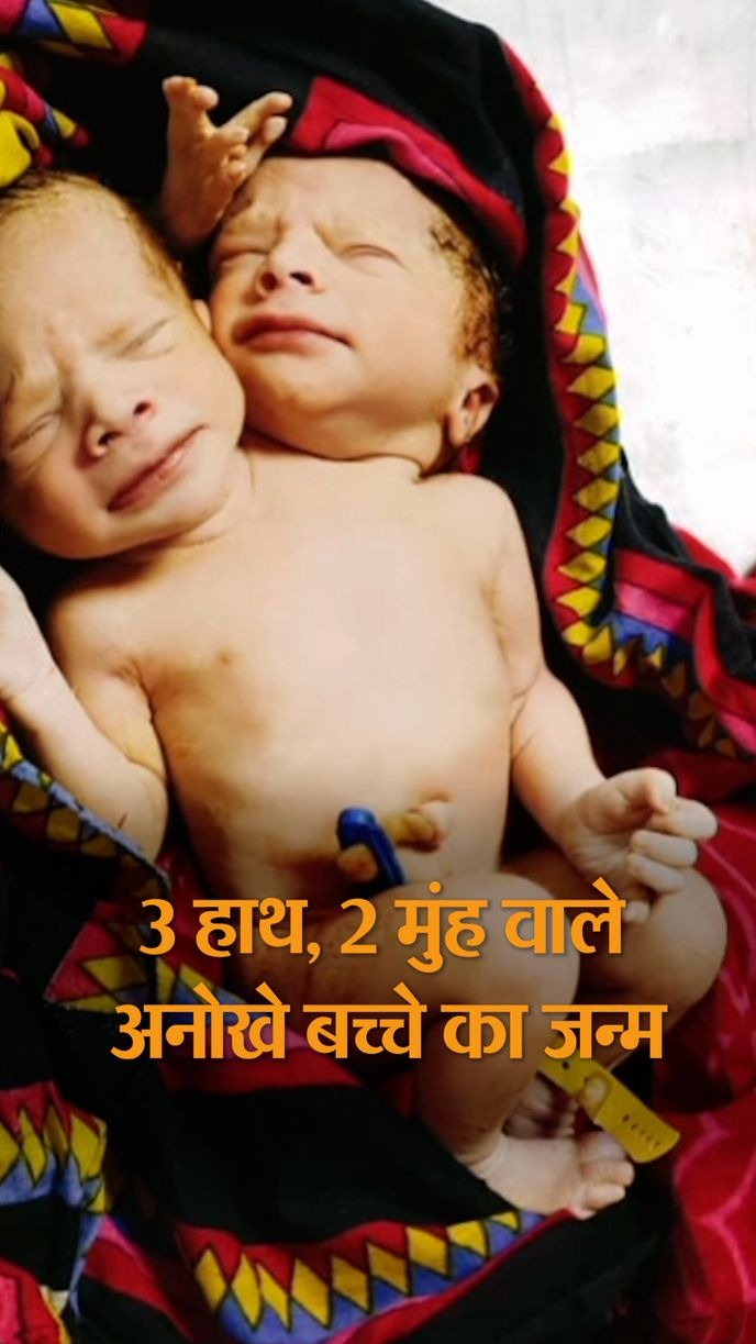 Ratlam में जन्मे दो सिर-तीन हाथ वाले बच्चे, Indore एमवाय हॉस्पिटल में किया रेफेर