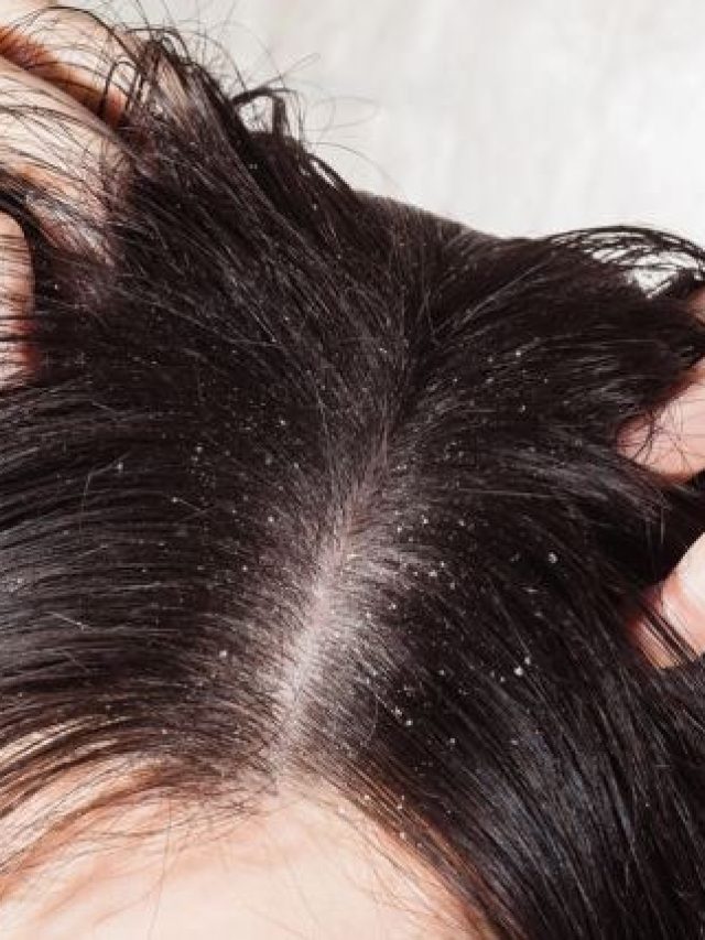 अब Dandruff को बोलें बाय – बाय, अपनाएं ये घरेलु उपाय