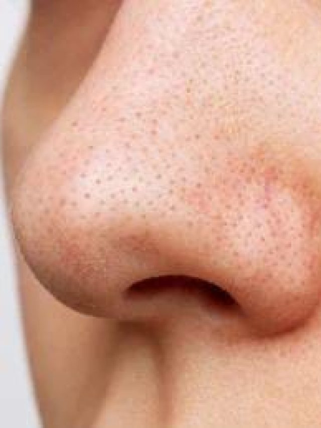 अगर आप भी हैं जिद्दी Blackheads से परेशान, तो अपनाएं ये घरेलू उपाय