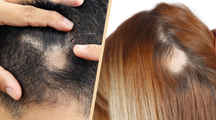 अगर आप भी है Hair Fall की समस्या से परेशान, तो डाइट में शामिल करें ये चीजें, मिलेगा फायदा