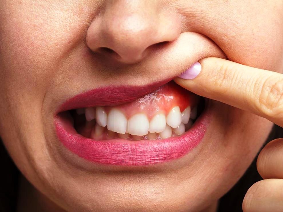 अगर आपके भी मसूड़ों से आता हैं खून, तो रखें इन बातों का खास ध्यान, वरना हो सकती हैं ये परेशानी