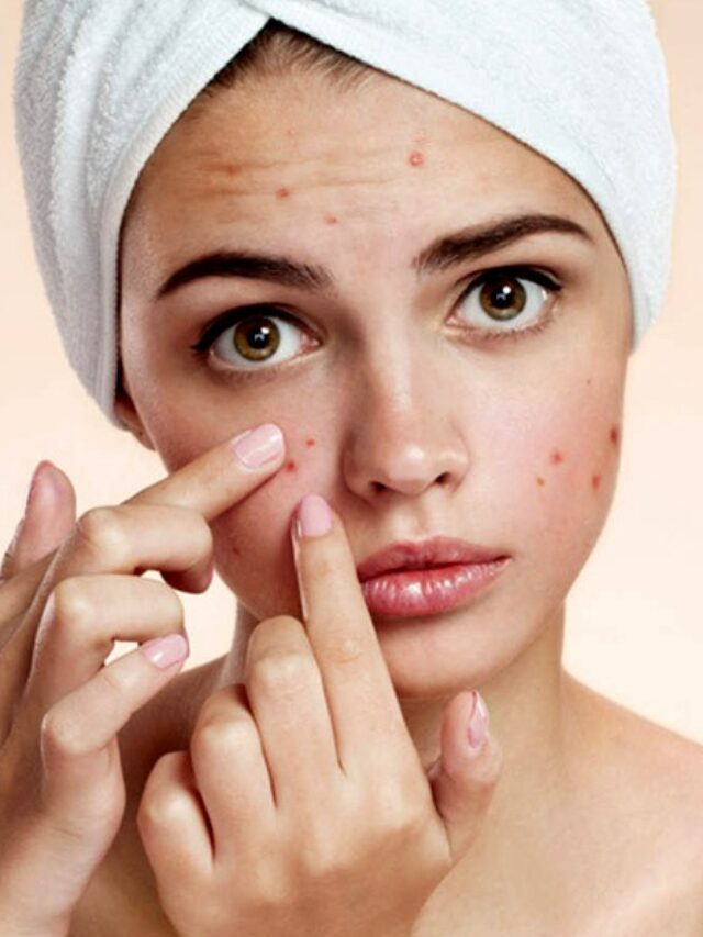 Blind Pimples: सिर्फ एक रात में गायब हो जाएंगे पिंपल्स, बस इन 4 घरेलु नुस्खों का करें इस्तेमाल