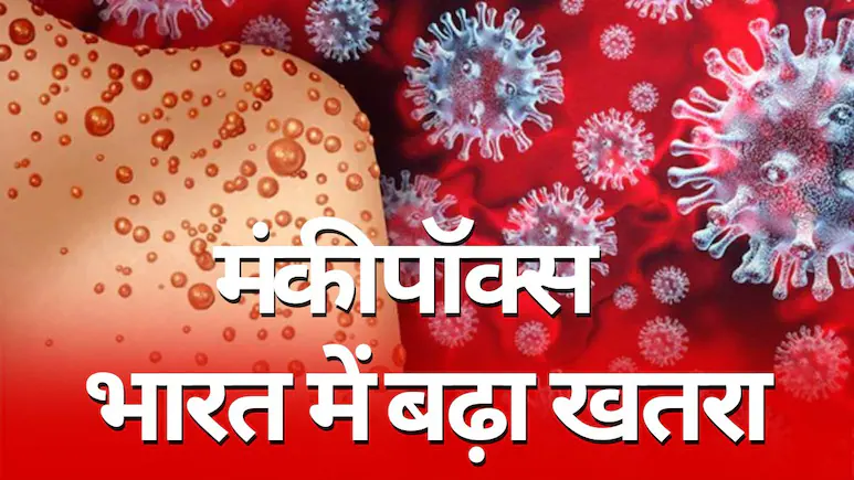 जिसका डर था वही हुआ, भारत में मिला Monkey-Pox का खतरनाक स्ट्रेन 1B, WHO ने बताया था हेल्थ इमरजेंसी