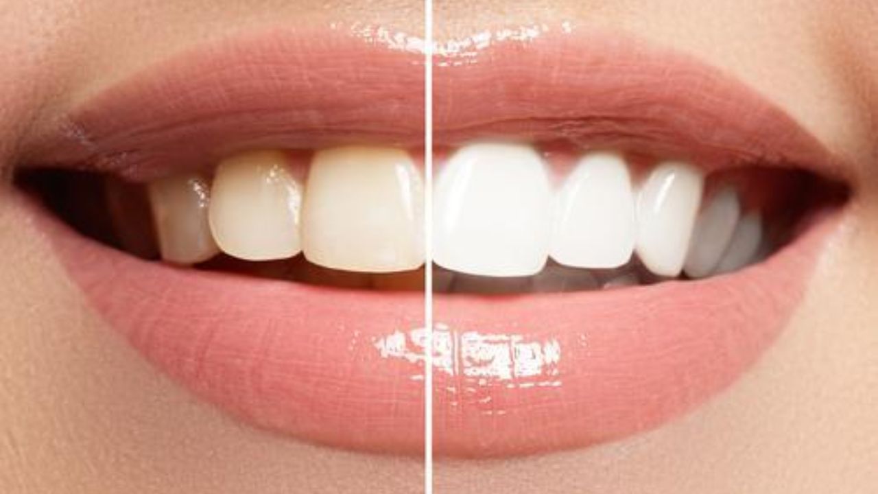 Teeth Whitening Remedy