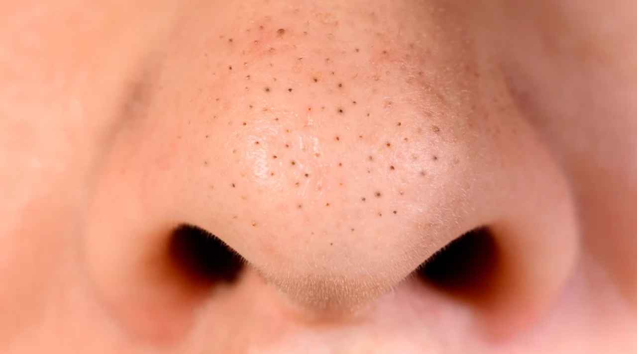 remove blackheads at home