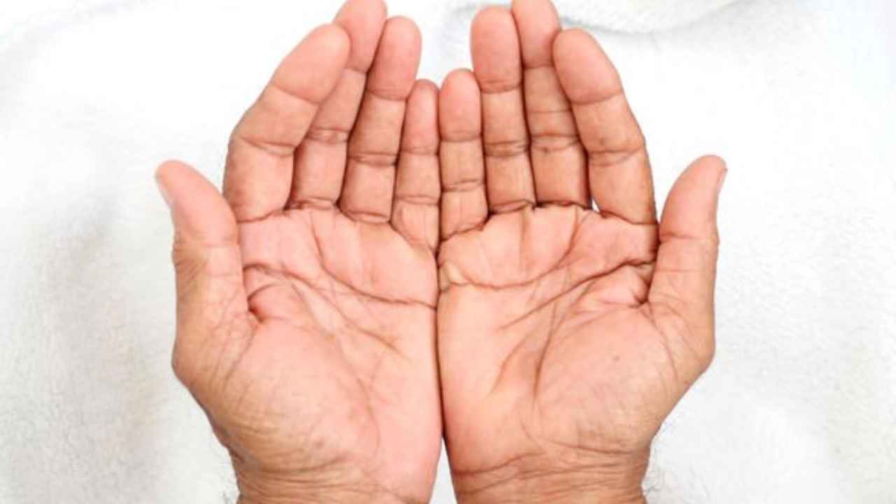 fatty liver symptoms on hands