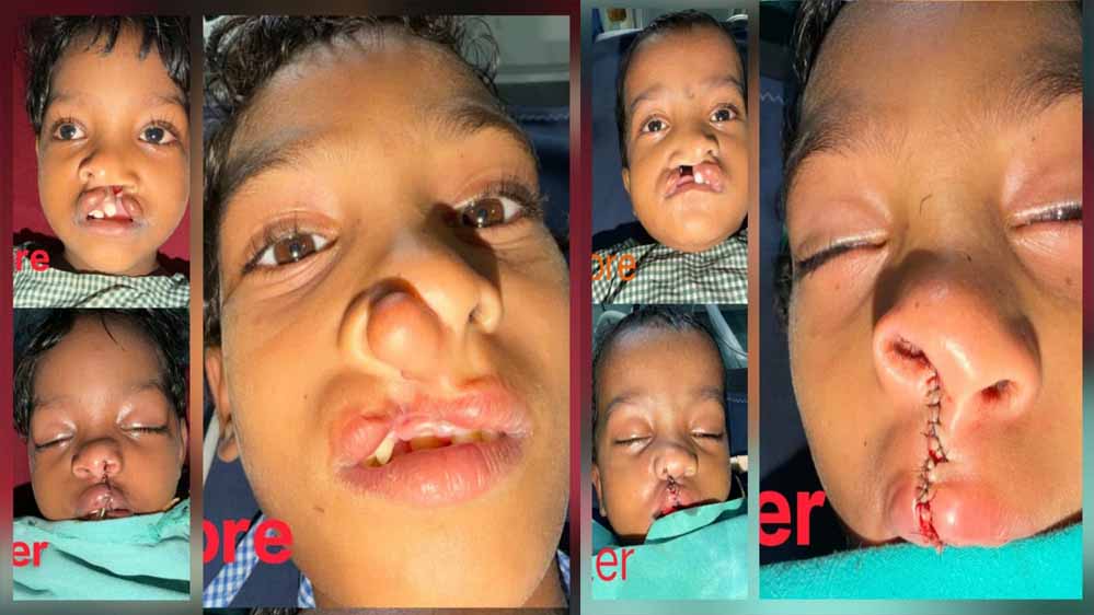 चिरायु योजना से जन्मजात समस्या से मिली राहत, तीन बच्चों के चेहरों पर लौटी मुस्कान